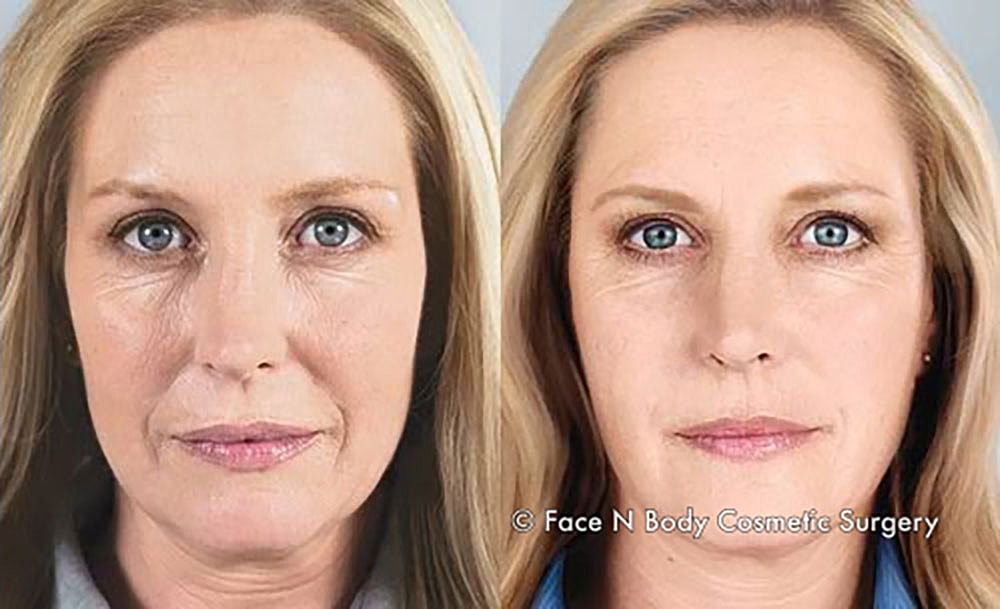 Injectables Before & After
