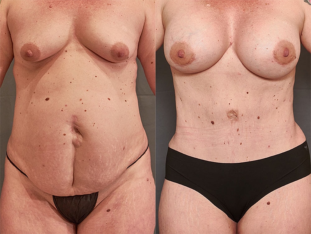 Liposuction Before & After