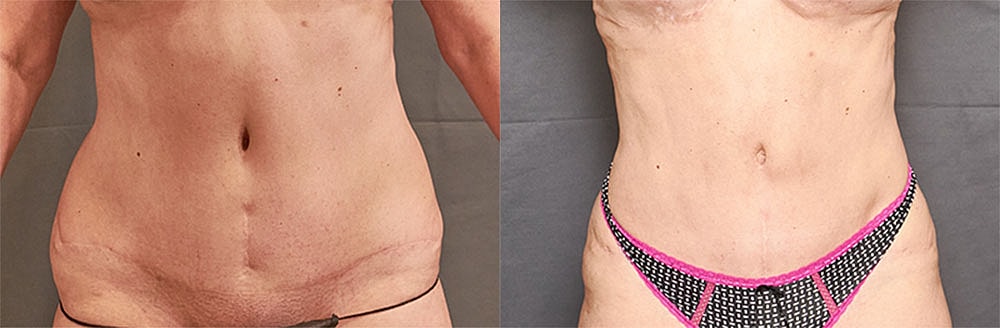 Liposuction Before & After