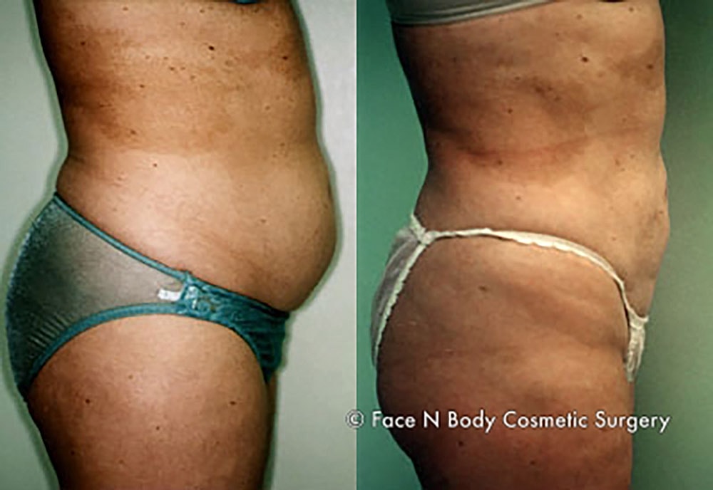 Liposuction Before & After