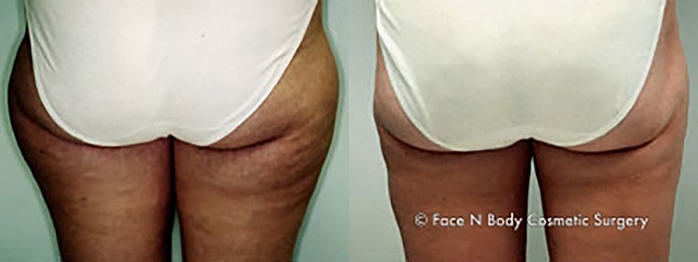 Liposuction Before & After