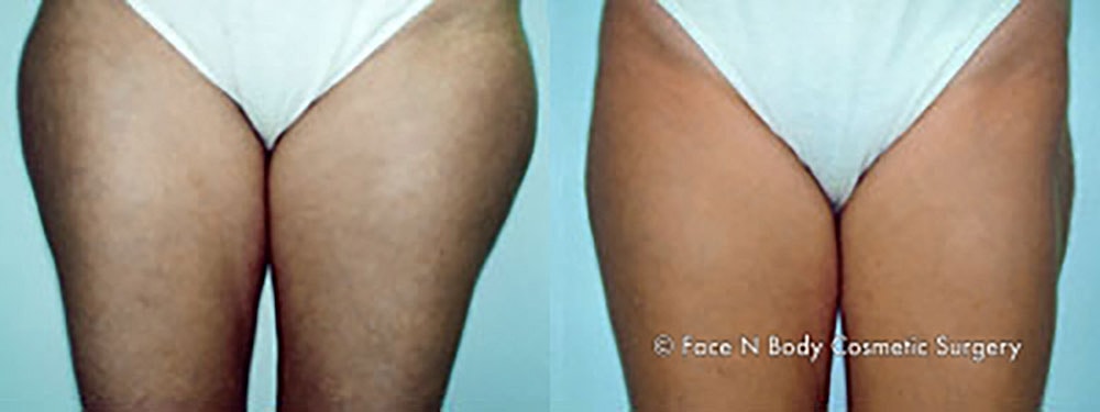 Liposuction Before & After