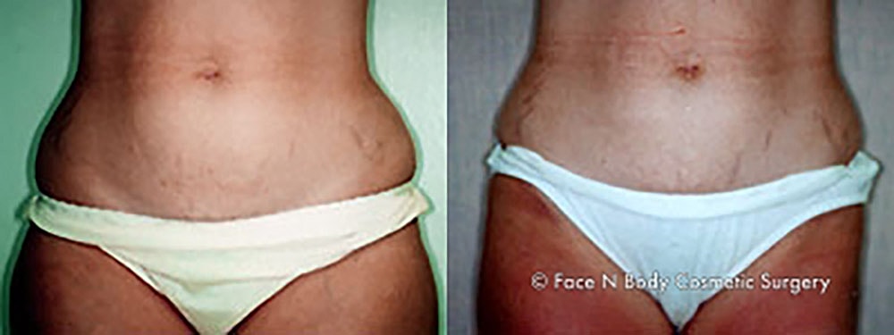 Liposuction Before & After