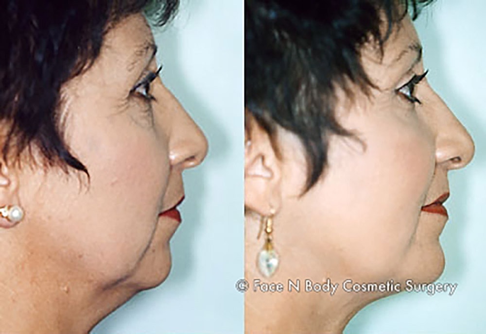 Liposuction Before & After