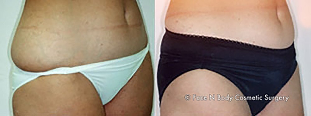 Liposuction Before & After