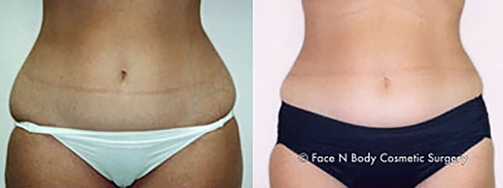 Liposuction Before & After