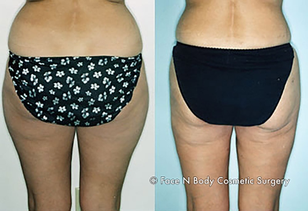 Liposuction Before & After