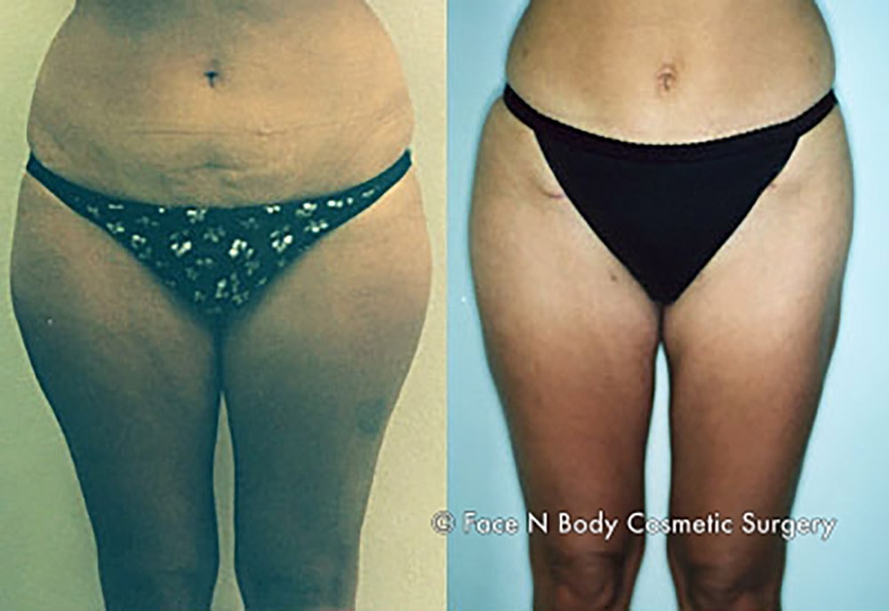 Liposuction Before & After