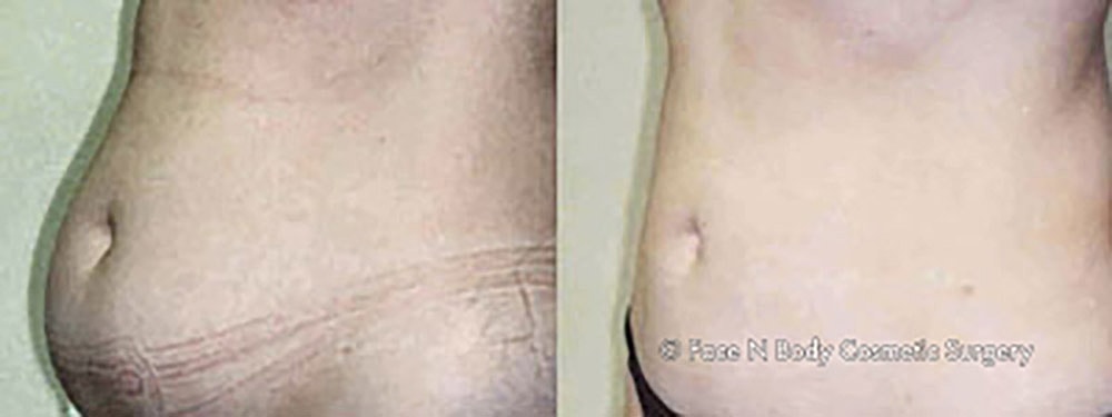 Liposuction Before & After