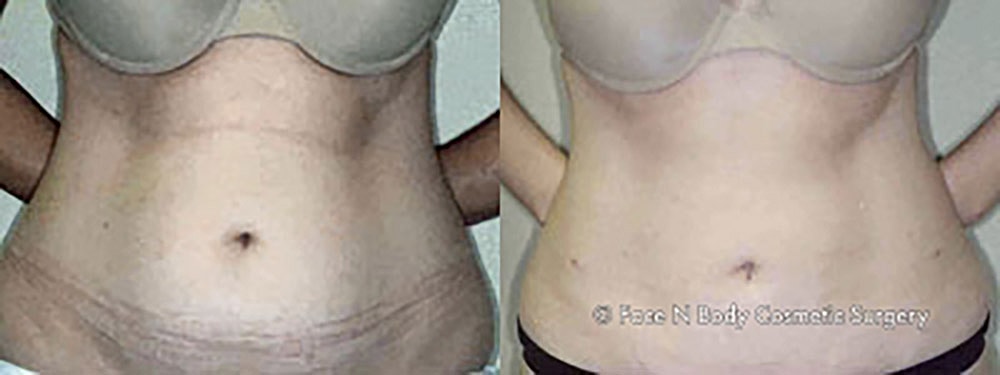Liposuction Before & After