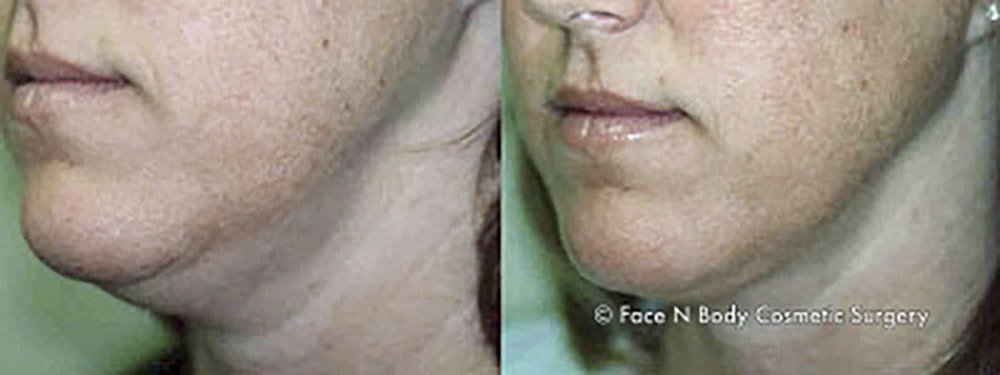 Liposuction Before & After