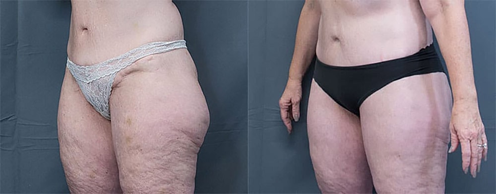 Liposuction Before & After