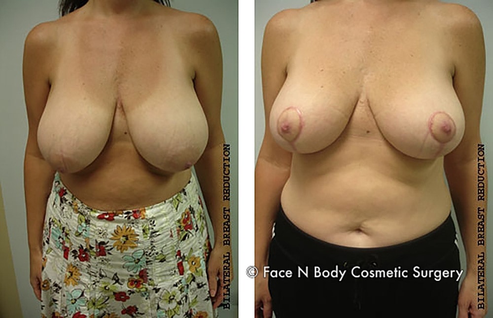 Breast Reduction Before & After