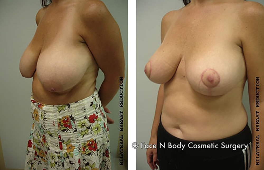 Breast Reduction Before & After