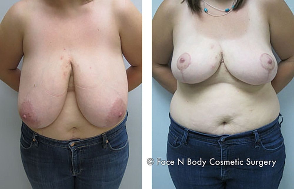 Breast Reduction Before & After