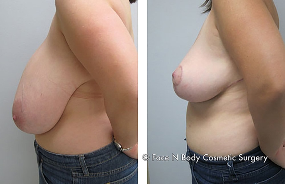 Breast Reduction Before & After