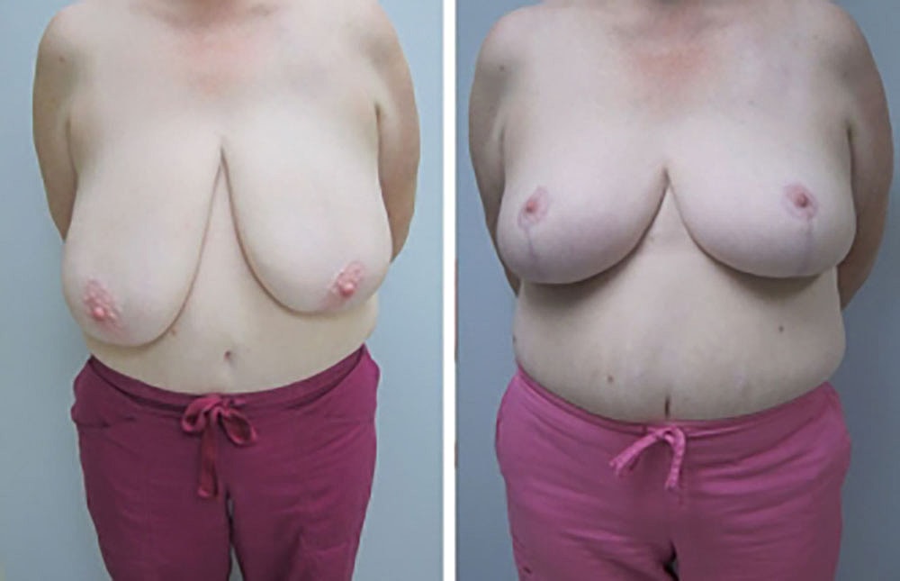 Breast Reduction Before & After