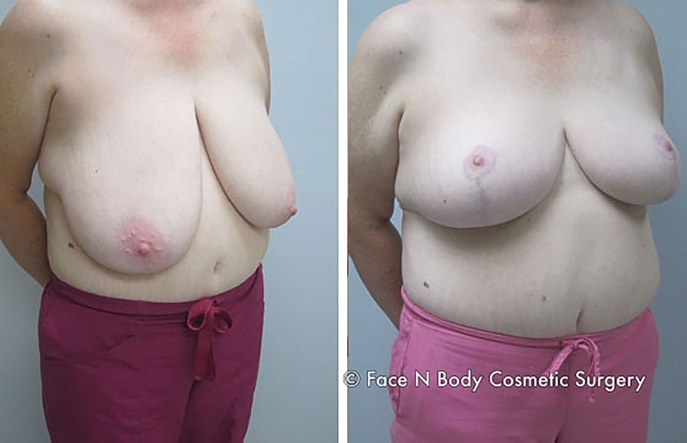 Breast Reduction Before & After
