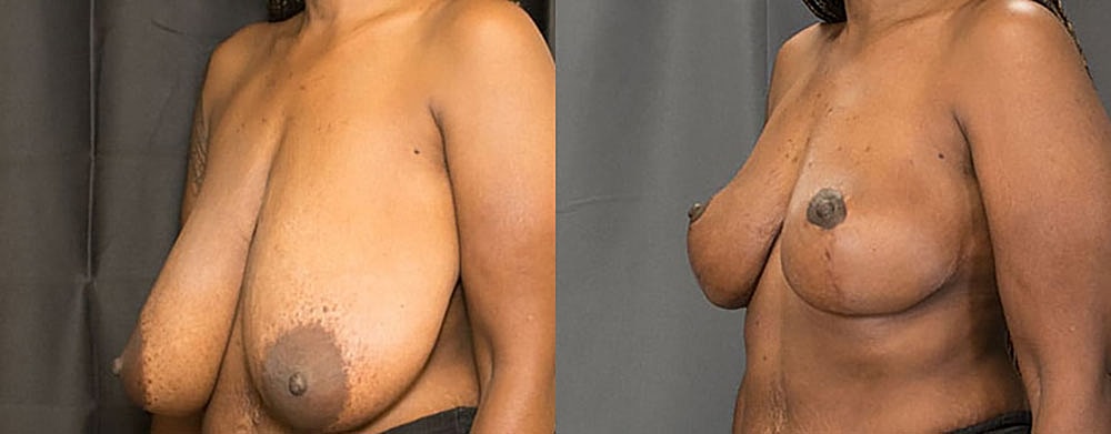 Breast Reduction Before & After