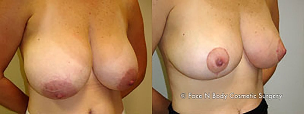 Breast Reduction Before & After