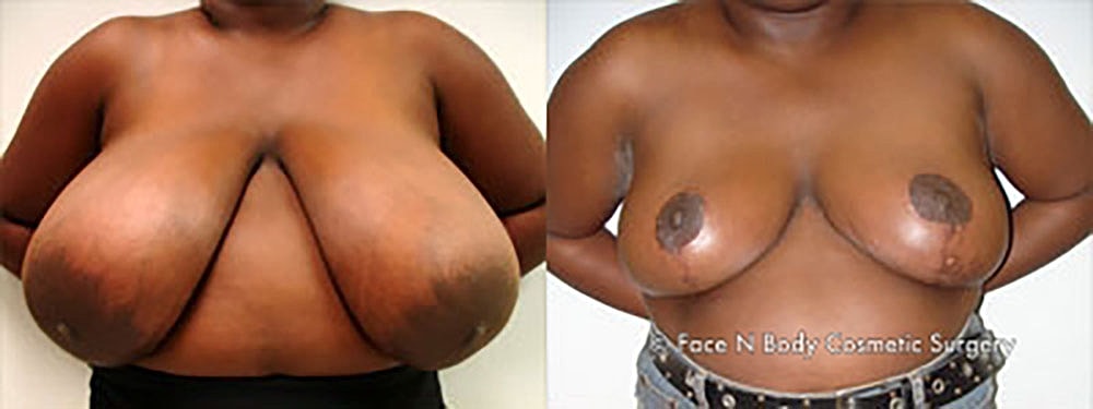Breast Reduction Before & After