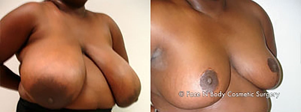 Breast Reduction Before & After