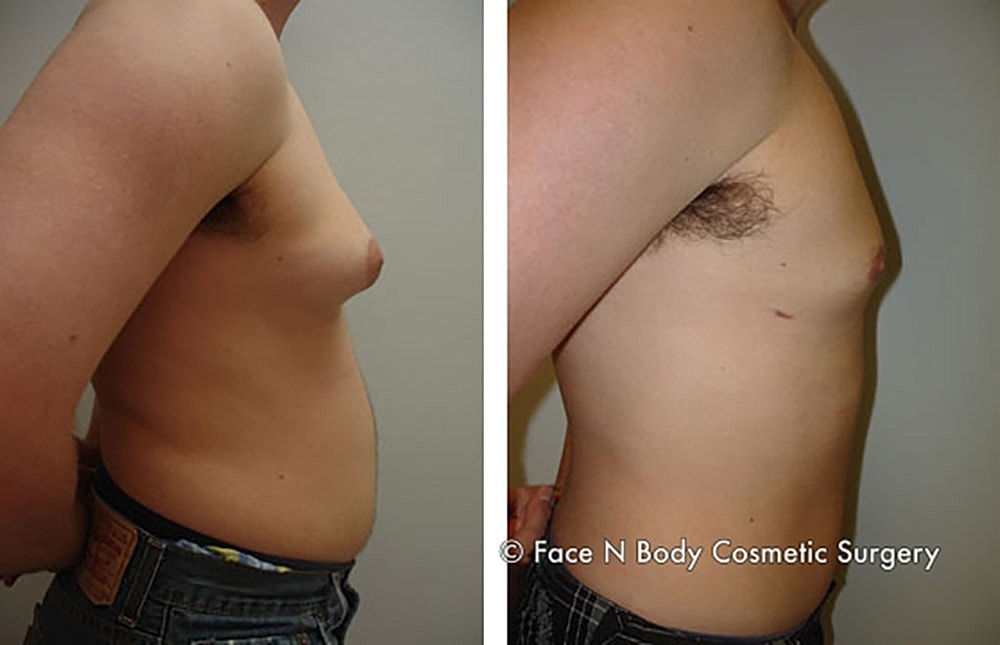 Male Breast Reduction Before & After