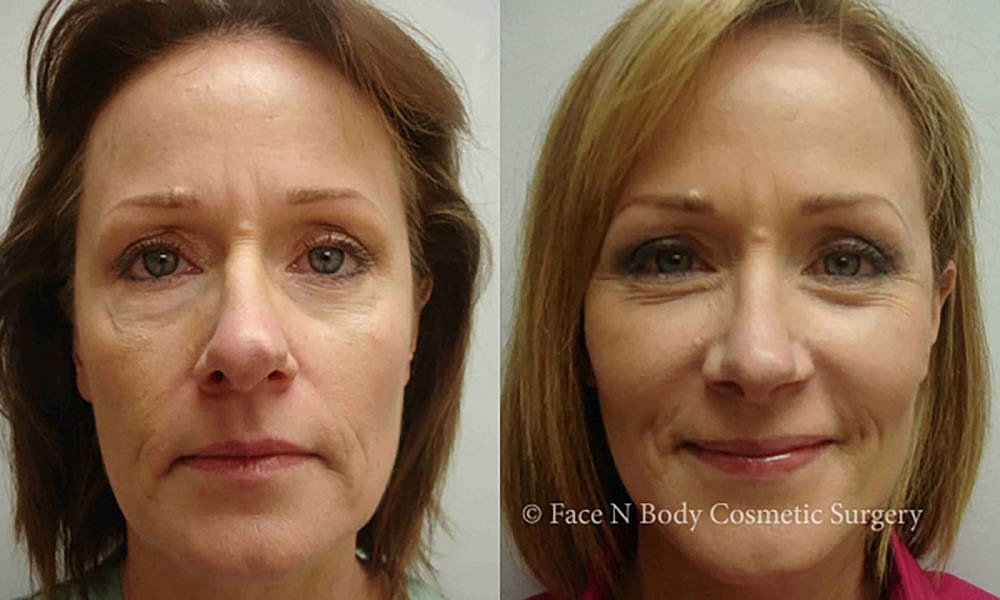 Facelift Before & After