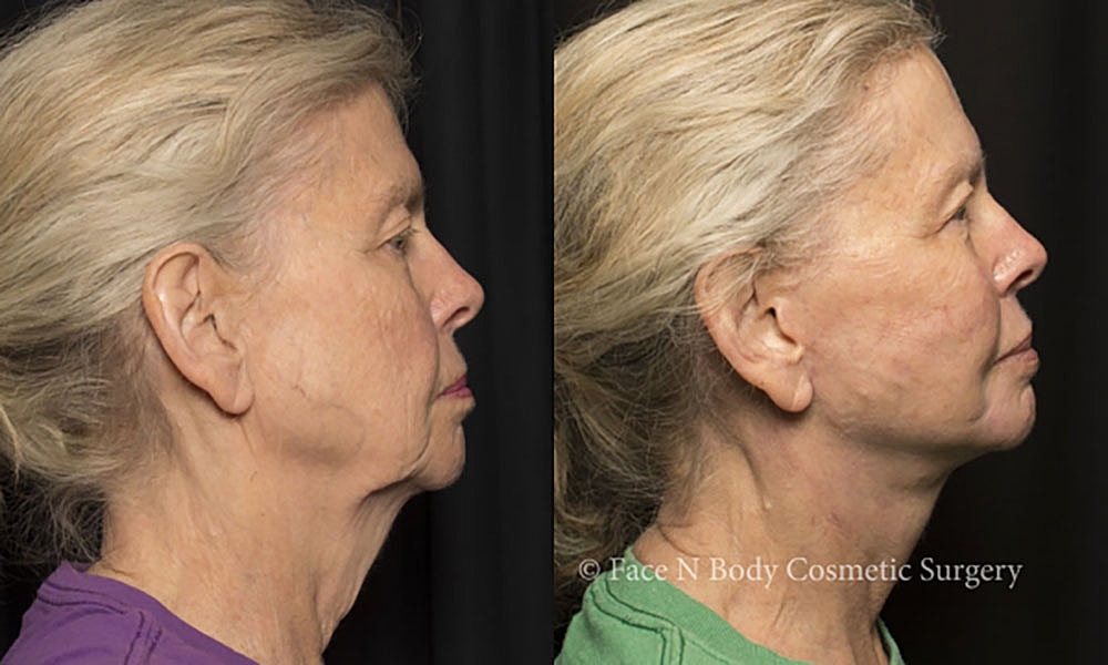 Facelift Before & After