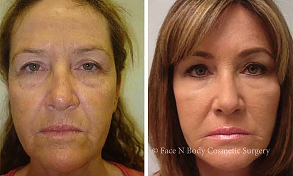 Facelift Before & After