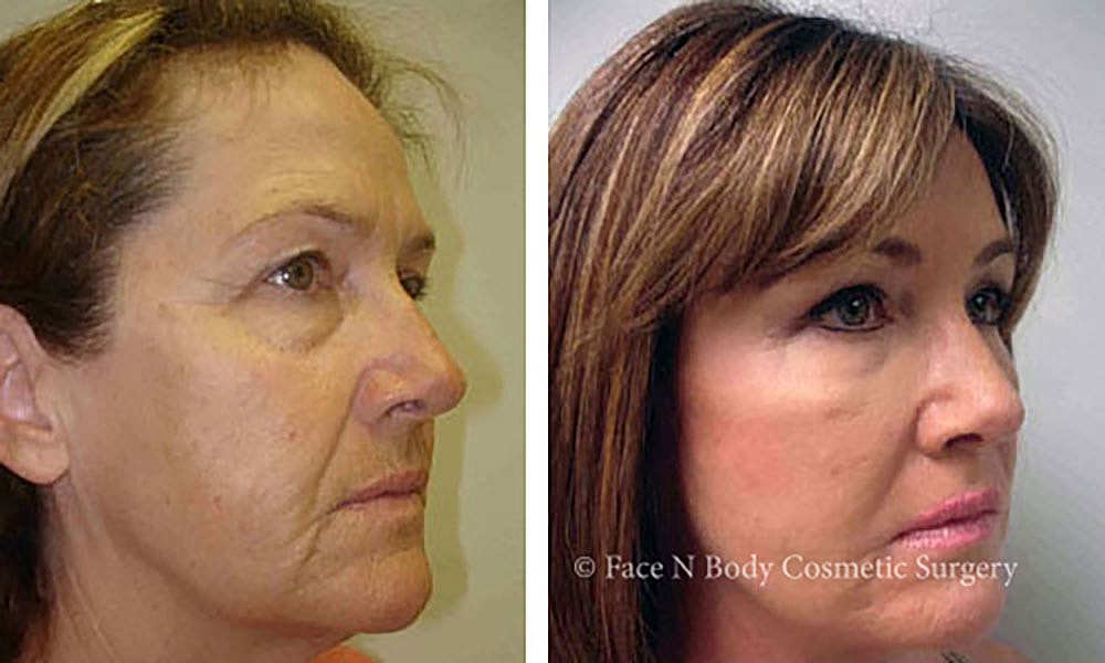 Facelift Before & After