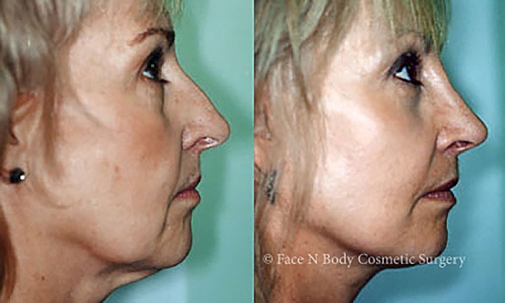 Facelift Before & After