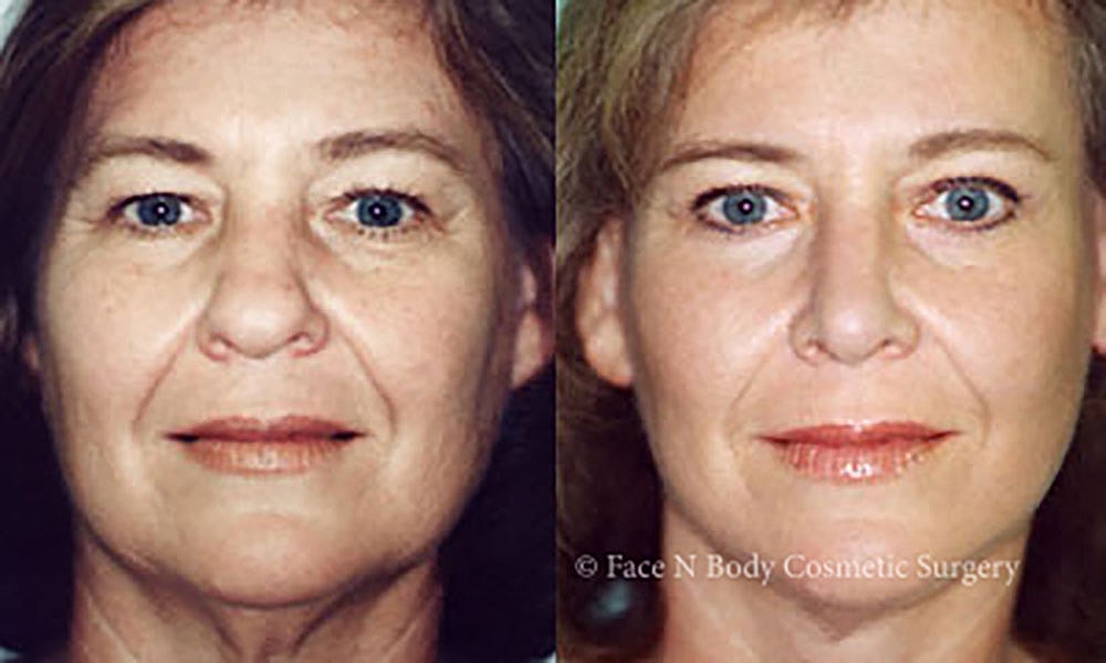 Facelift Before & After