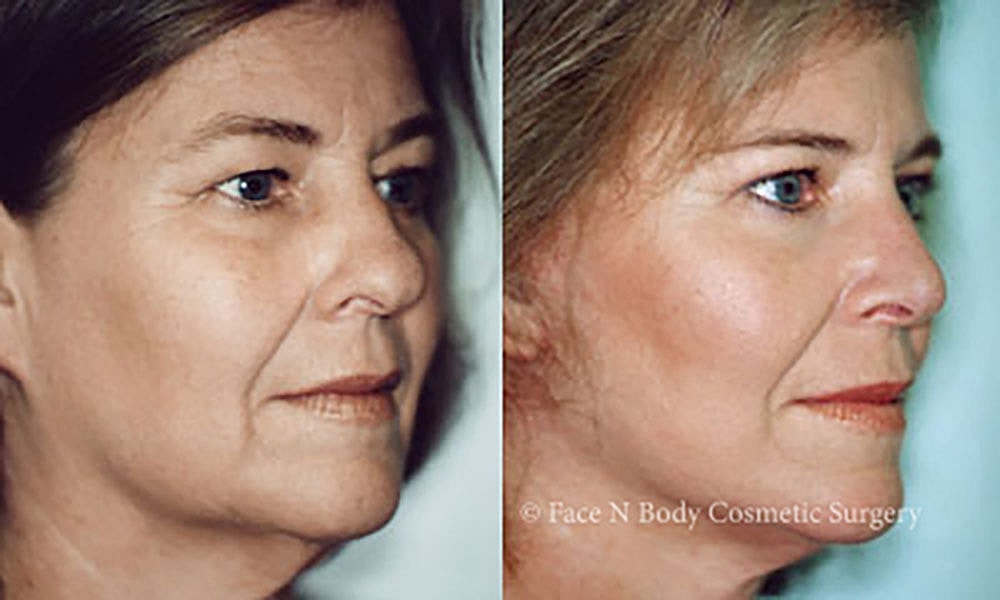Facelift Before & After