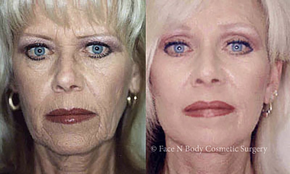 Facelift Before & After