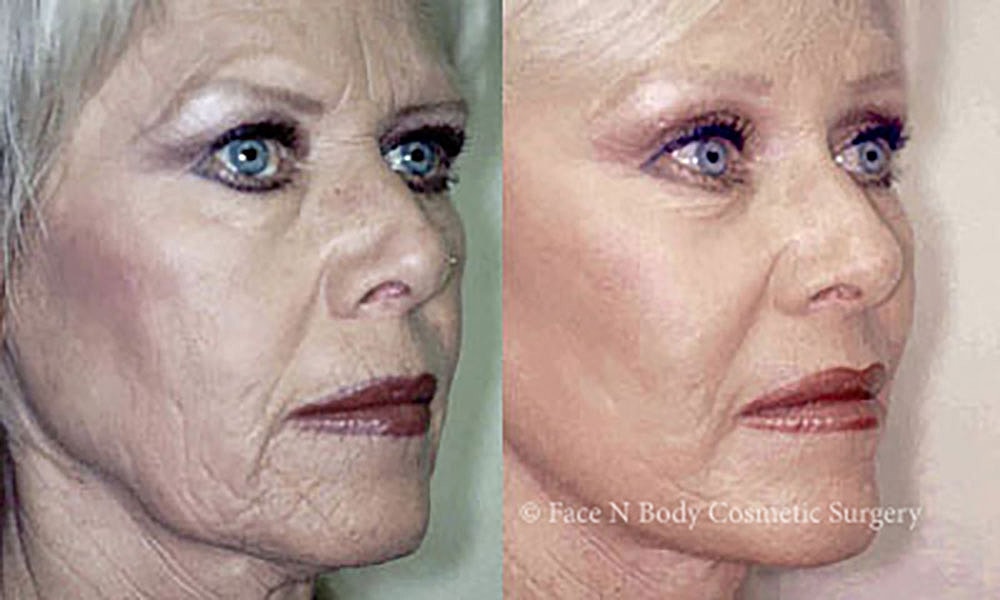 Facelift Before & After