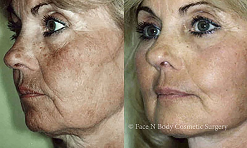 Facelift Before & After