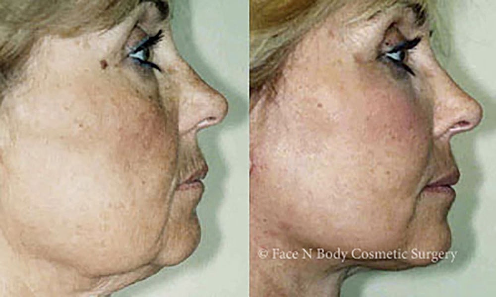 Facelift Before & After