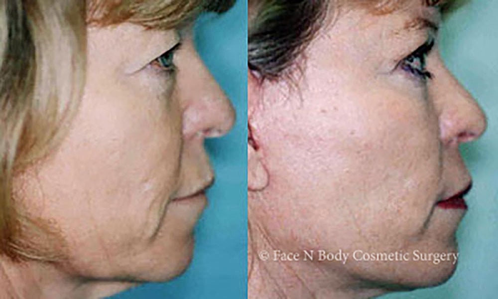 Facelift Before & After
