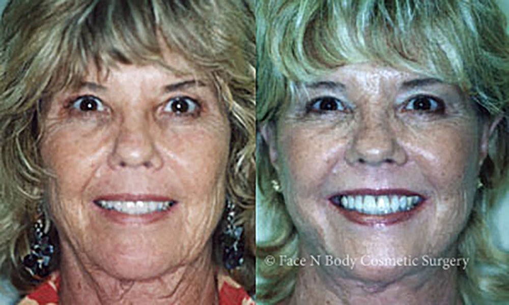 Facelift Before & After