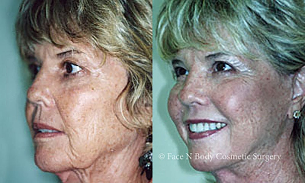 Facelift Before & After