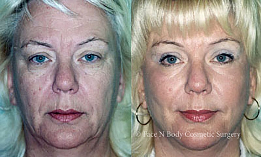 Facelift Before & After