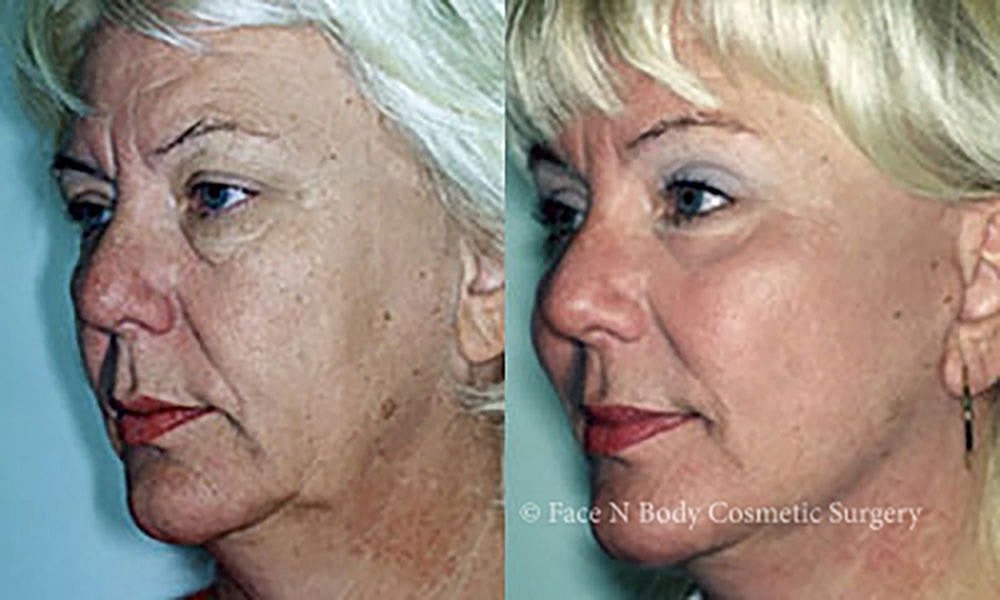 Facelift Before & After