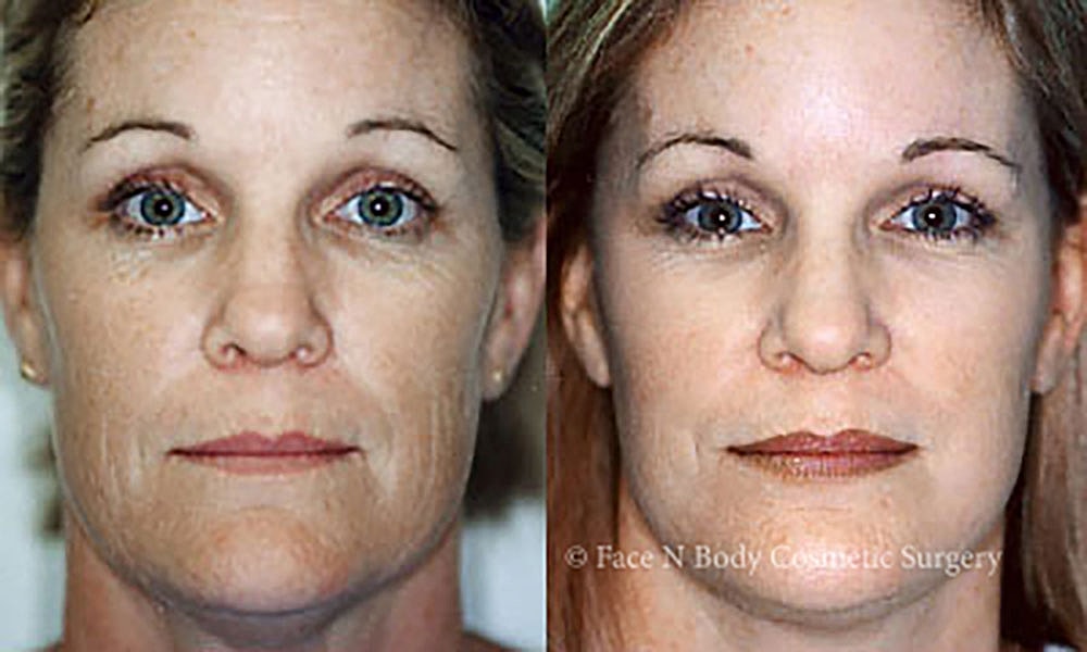 Facelift Before & After