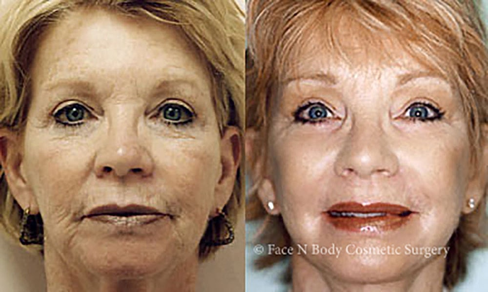 Facelift Before & After