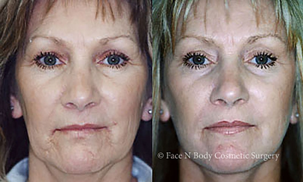 Facelift Before & After
