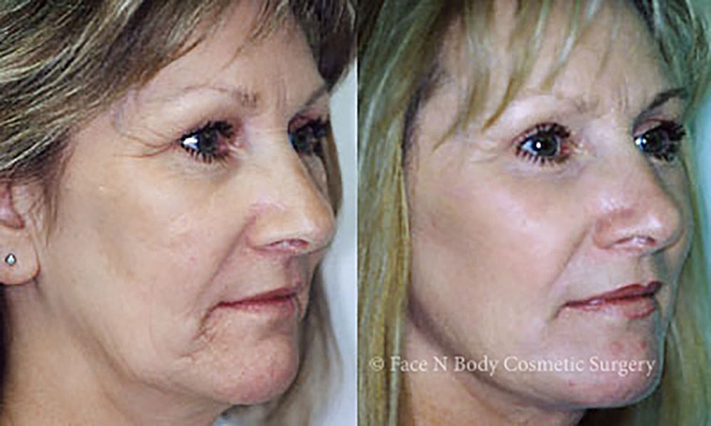 Facelift Before & After