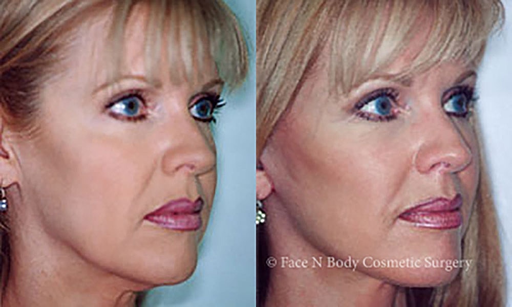 Facelift Before & After