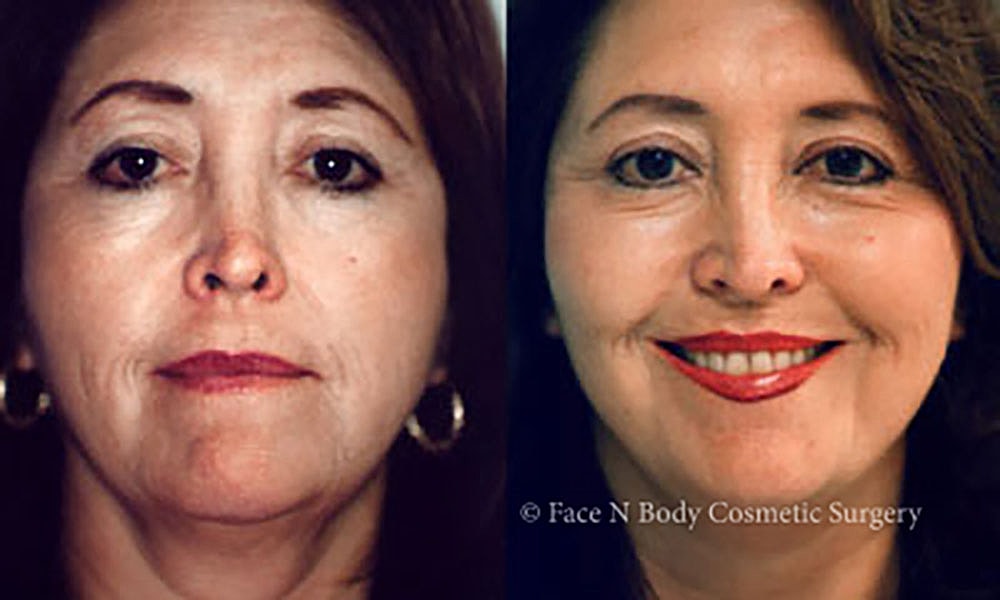 Facelift Before & After
