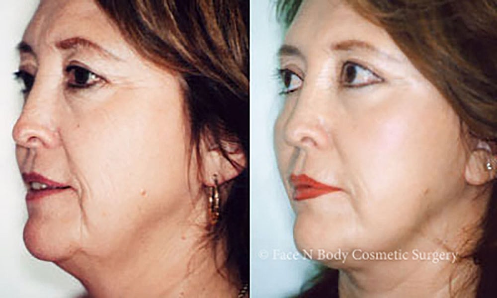 Facelift Before & After